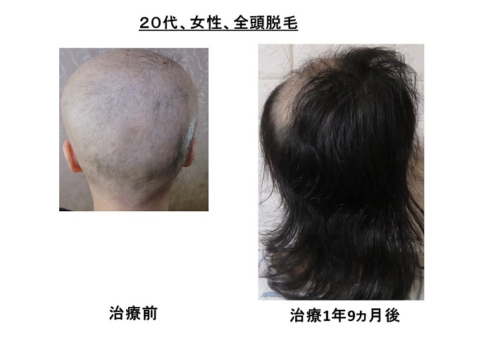 円形脱毛症　病院